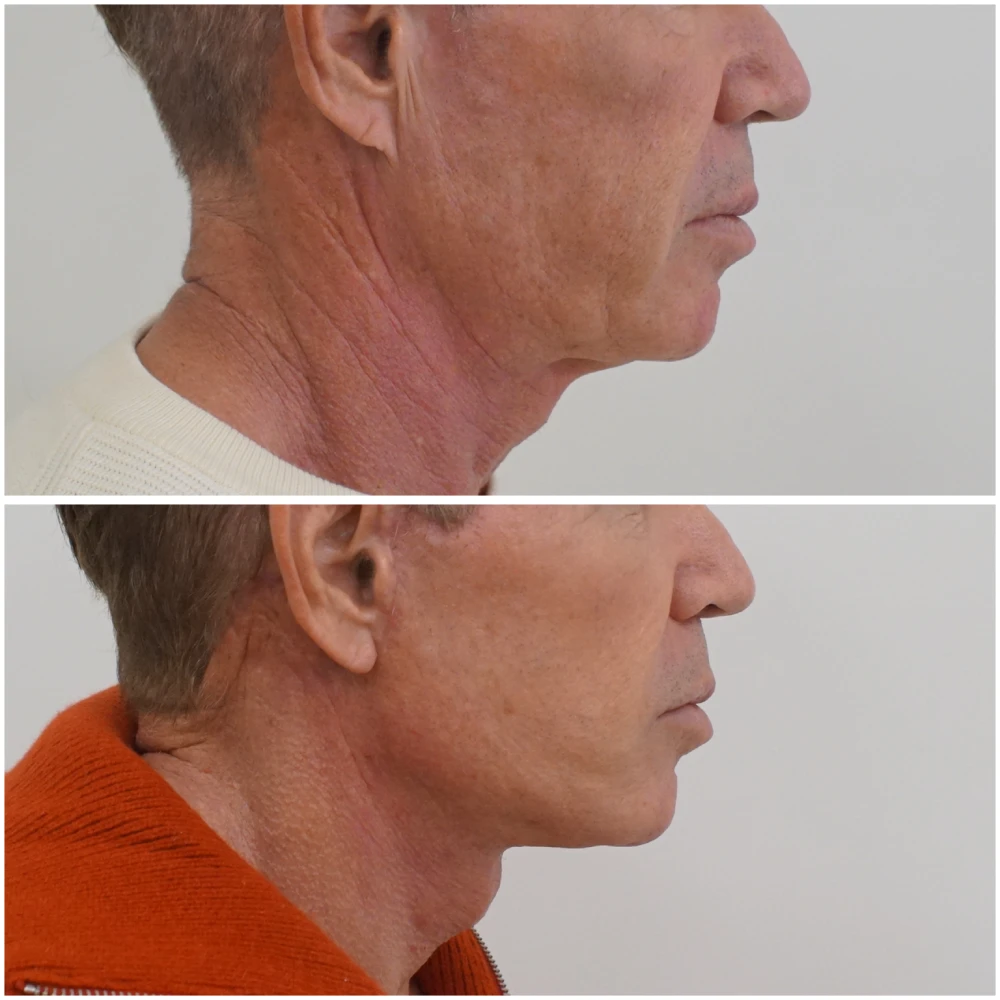 mejor cirujano lifting facial malaga