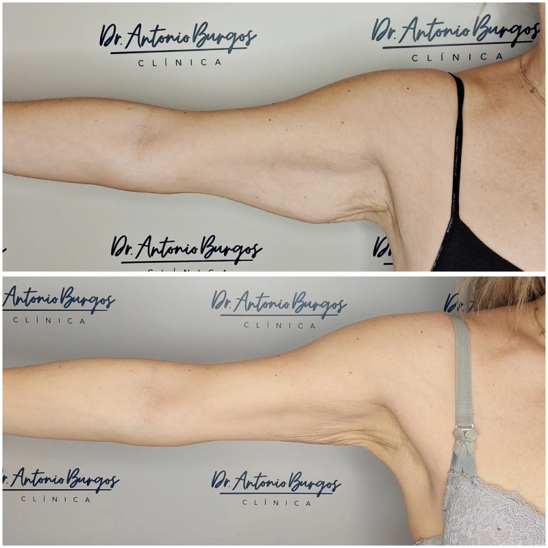 antes y despues endolift en brazos