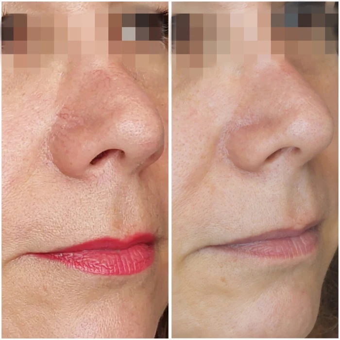 resultados tratamiento arañas vasculares malaga