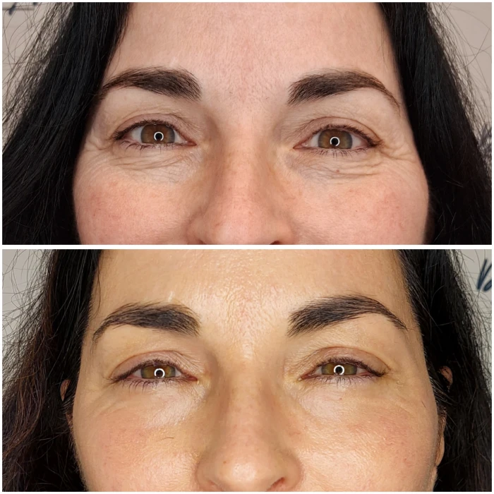 arrugas perioculares 1 dr antonio burgos