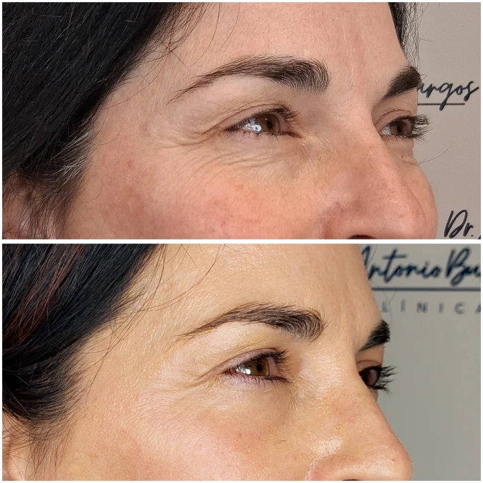 arrugas perioculares 2 dr antonio burgos