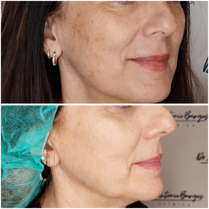 ipl manchas 1 dr antonio burgos