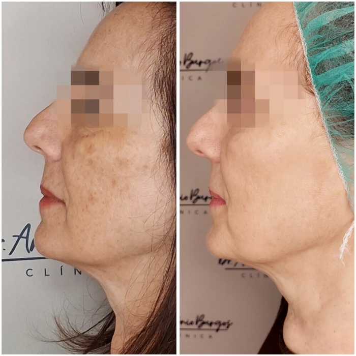 ipl manchas 2 dr antonio burgos