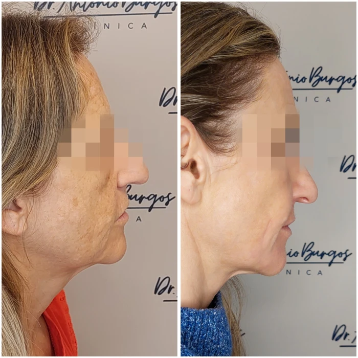 ipl tratamiento rellenos dermicos dr antonio burgos 2