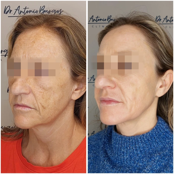 ipl tratamiento rellenos dermicos dr antonio burgos