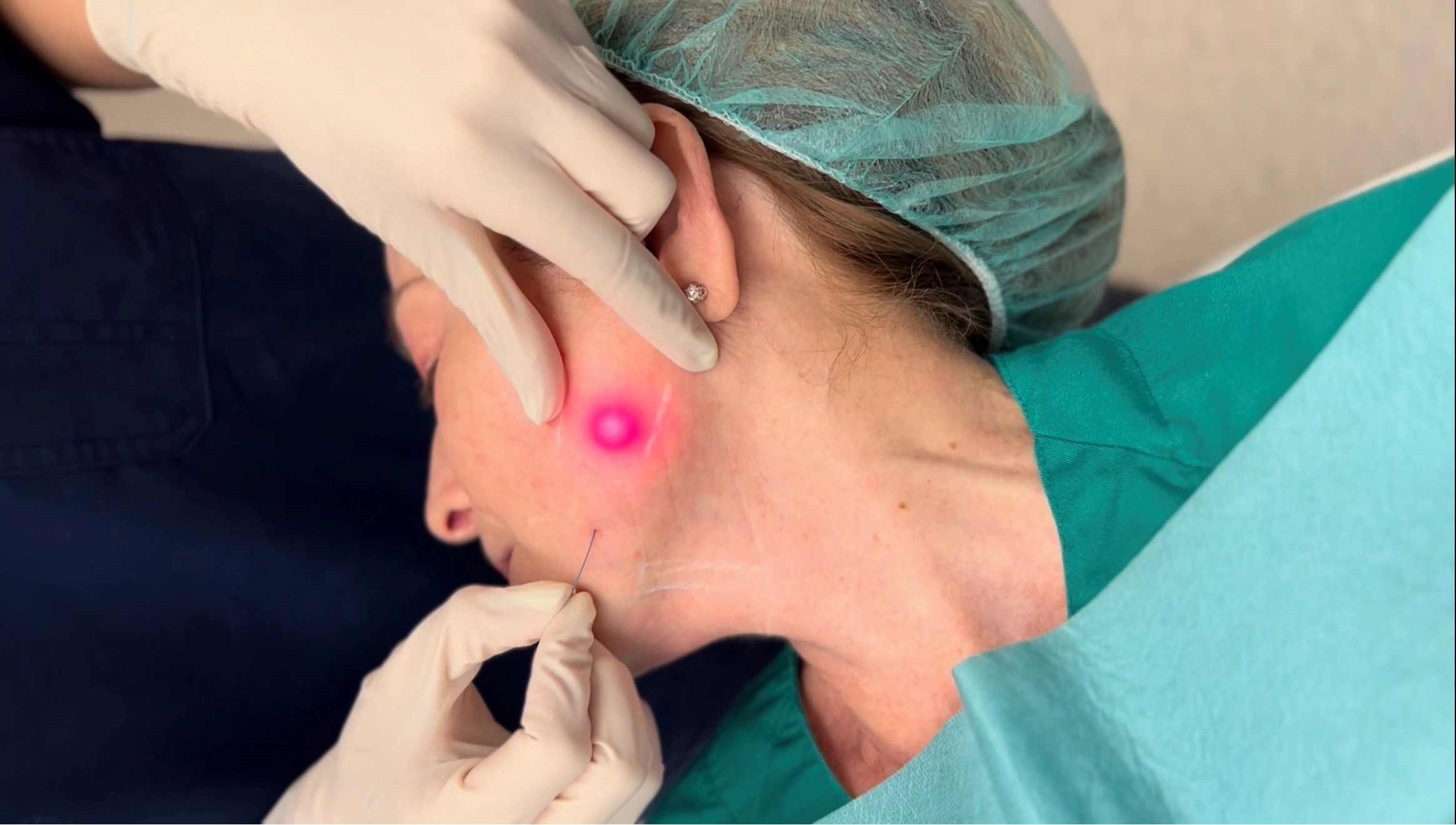 endolift malaga precio