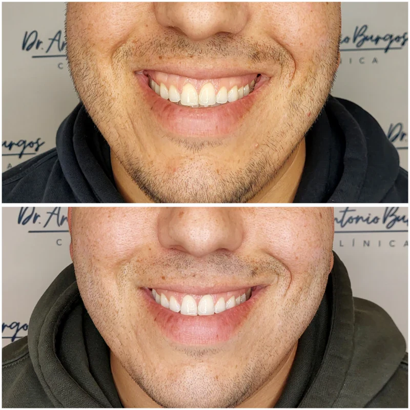 sonrisa gingival acido hialuronico malaga