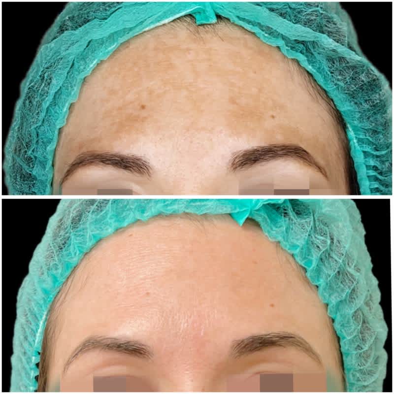 tratamiento melasma malaga antes despues 4.jpeg