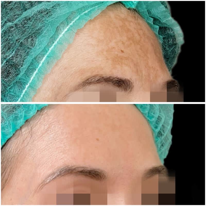 tratamiento melasma malaga antes despues 6.jpeg