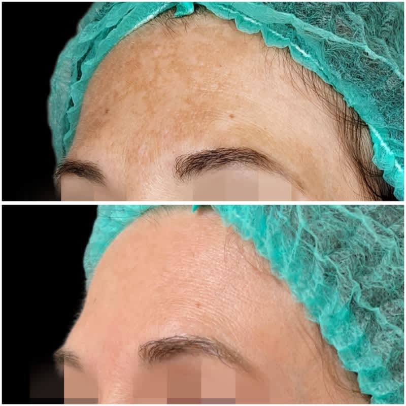 tratamiento melasma malaga antes despues 8.jpeg