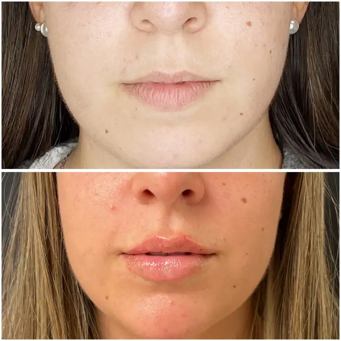 antes y despues aumento de labios con acido hialuronico en malaga