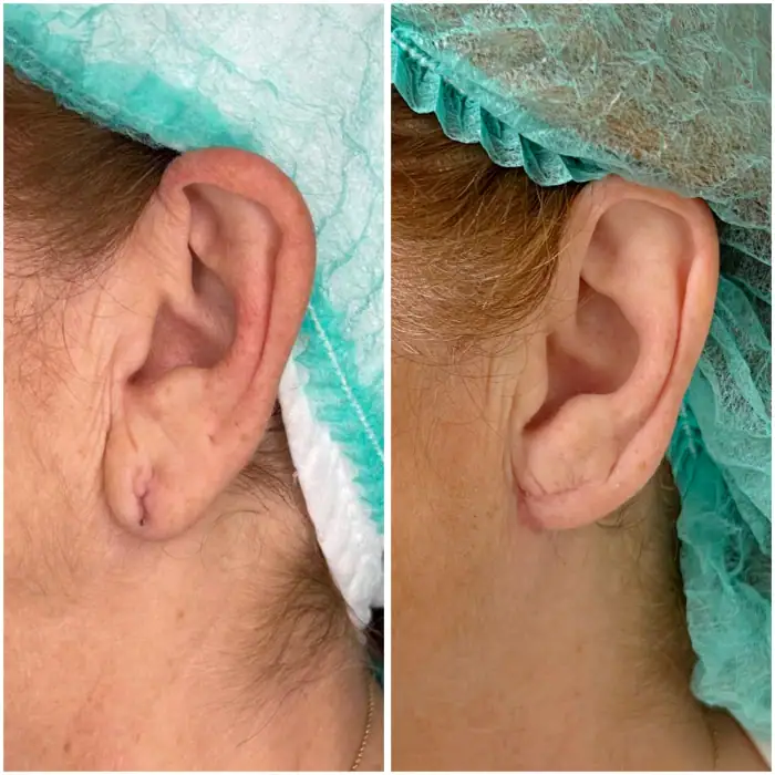 antes y despues en intervencion de lobuloplastia en malaga