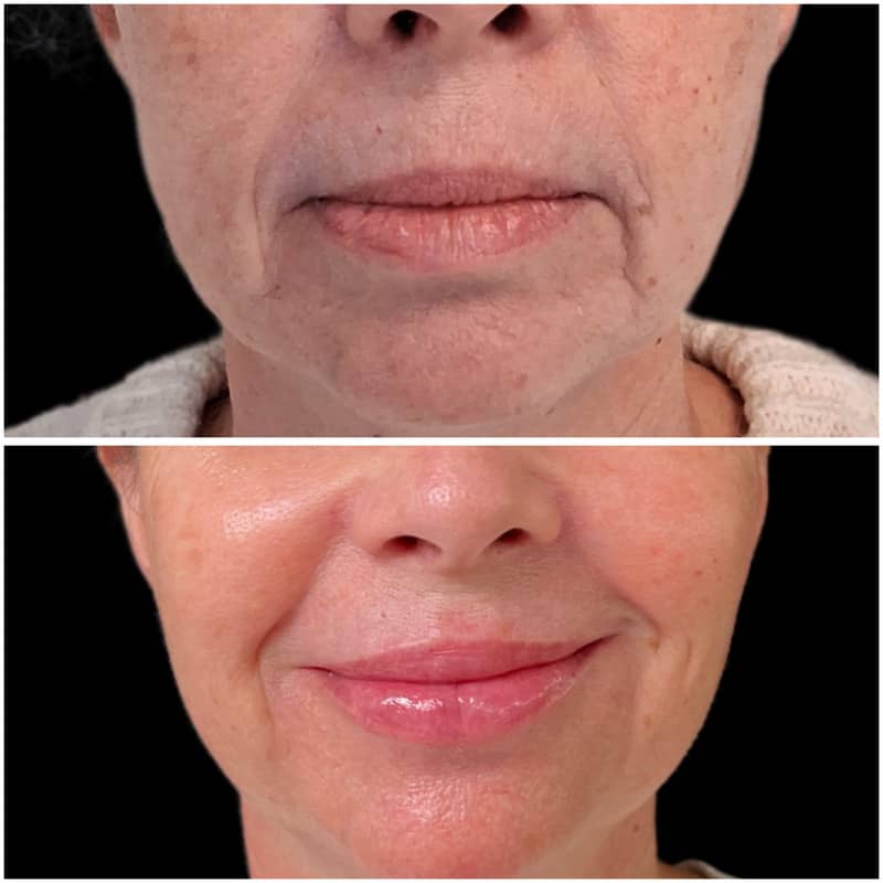 Antes y después de un aumento de labios con ácido hialurónico