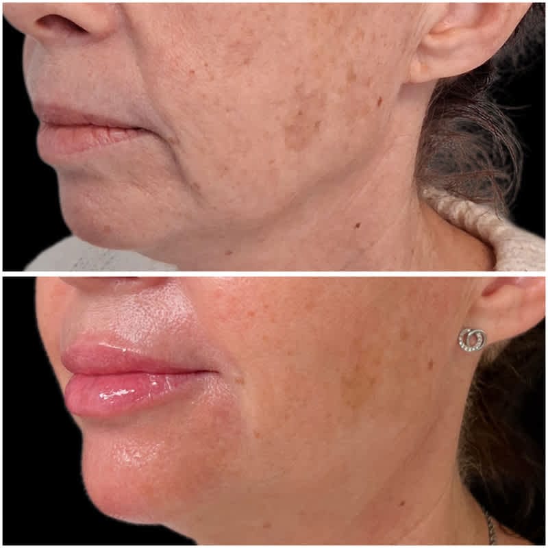 Resultado de aumento de labios con ácido hialurónico visto de perfil