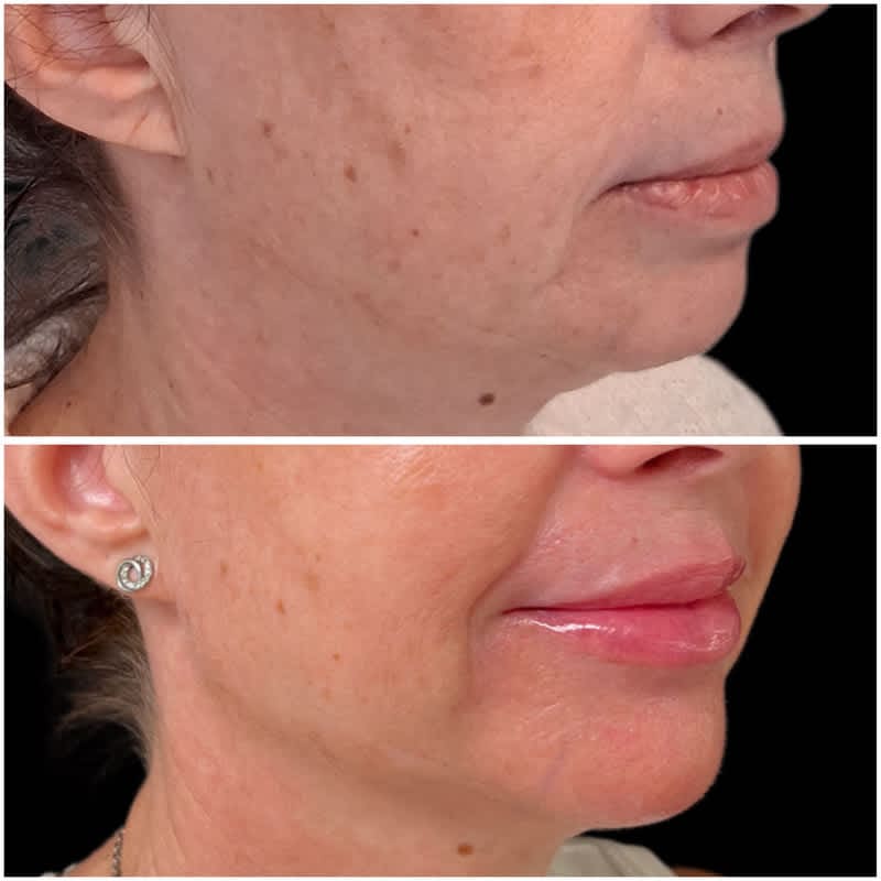 Antes y después de un aumento de labios con ácido hialurónico de perfil