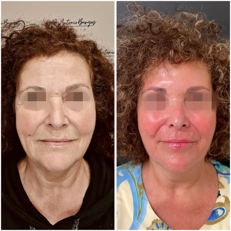 Antes y después de un tratamiento facial combinado con láser CO2, neuromoduladores y ácido hialurónico