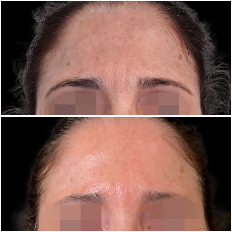 Antes y después de un tratamiento de microneedling para mejorar la textura de la piel