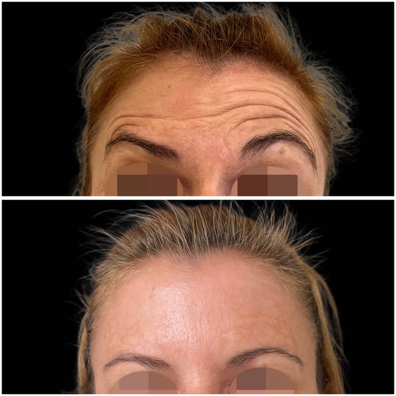 Antes y después del tratamiento de las arrugas de la frente con neuromoduladores