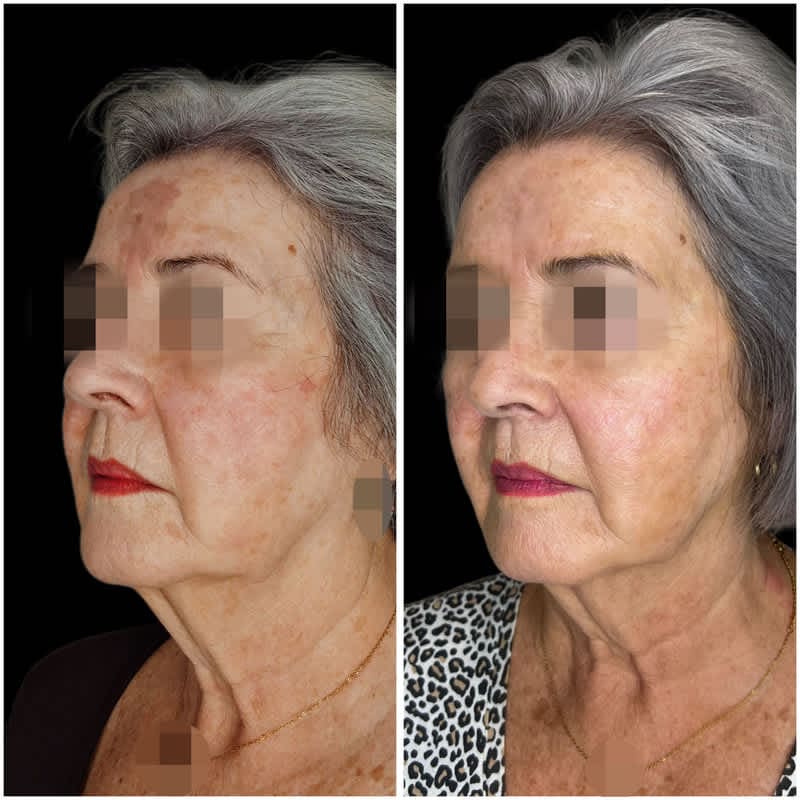 Resultado de un peeling químico para mejorar las manchas y el tono de la piel