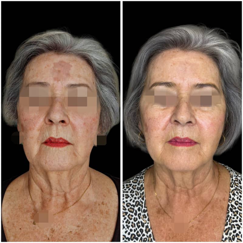 Antes y después de un peeling químico para tratar manchas faciales