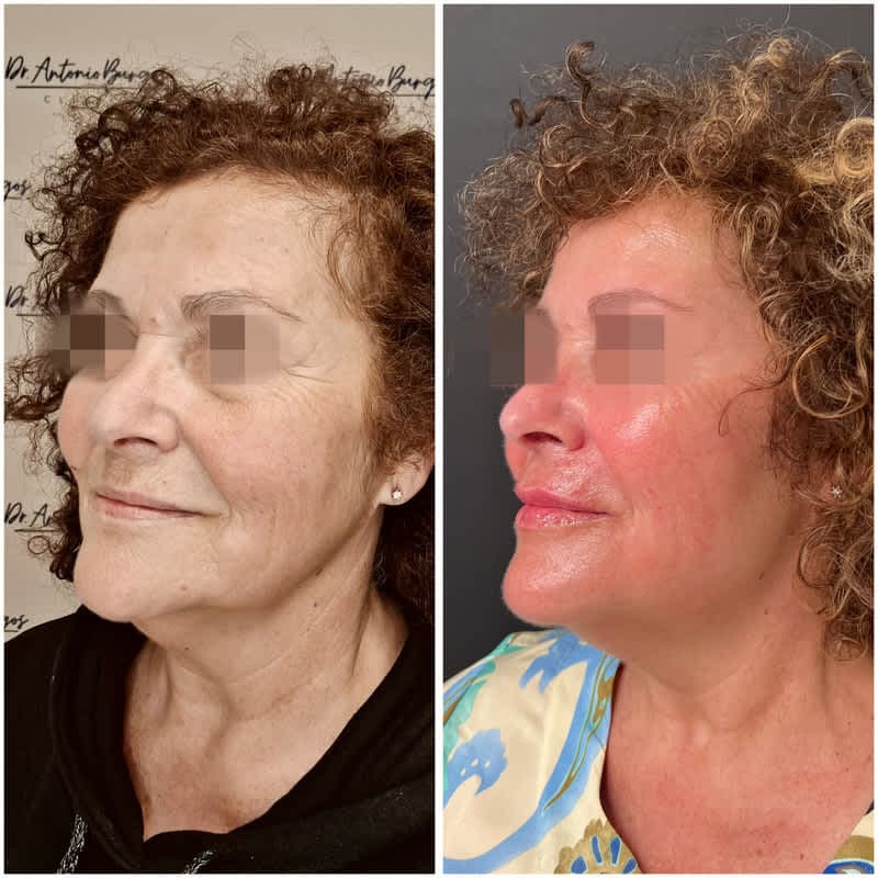 Antes y después de un rejuvenecimiento facial con láser CO2, neuromoduladores y ácido hialurónico