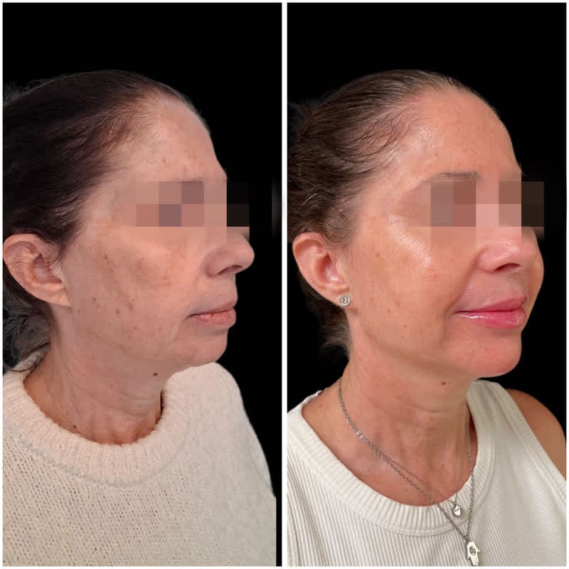 Antes y después de un relleno facial con ácido hialurónico para mejorar el perfil