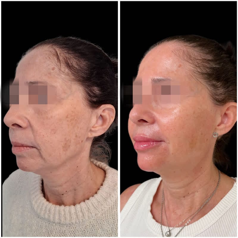 Resultado de un tratamiento de relleno facial con ácido hialurónico