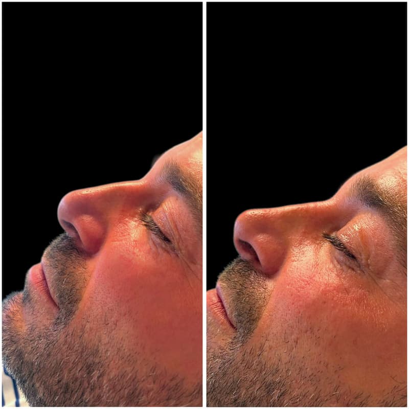 Antes y después de una rinomodelación sin cirugía con ácido hialurónico
