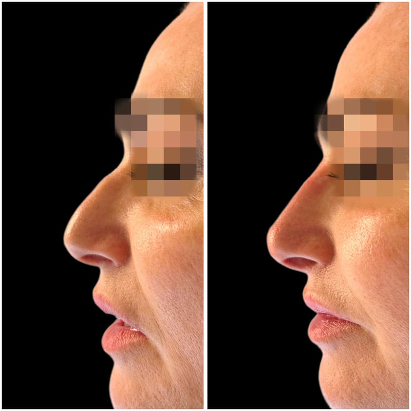 Resultado de rinomodelación sin cirugía para mejorar el perfil nasal