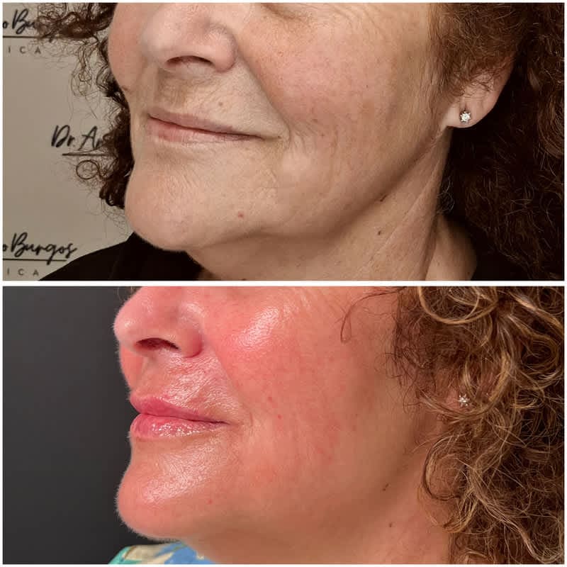 Resultado antes y después de un tratamiento de aumento de labios con ácido hialurónico