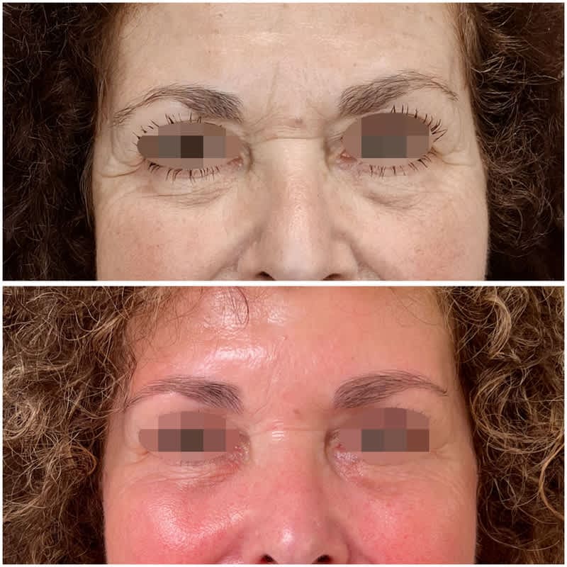 Resultado de rejuvenecimiento facial con láser CO2 y neuromoduladores